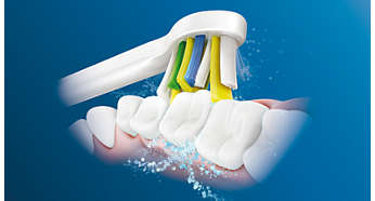 Efektywne czyszczenie przestrzeni między zębami a aparatem ortodontycznym